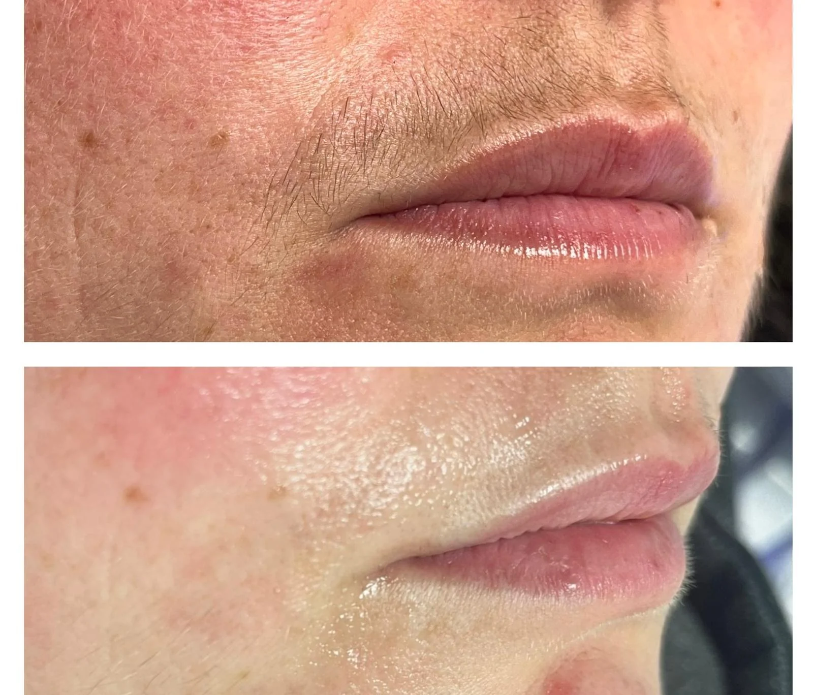 Antes e depois no buço: pelos visíveis em cima e pele mais lisa embaixo