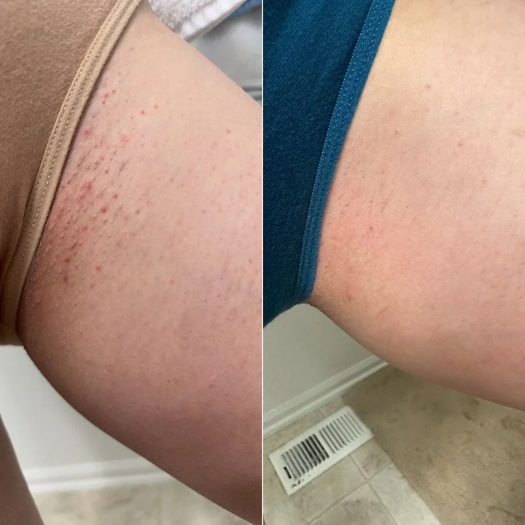 Antes e depois na virilha, lado a lado