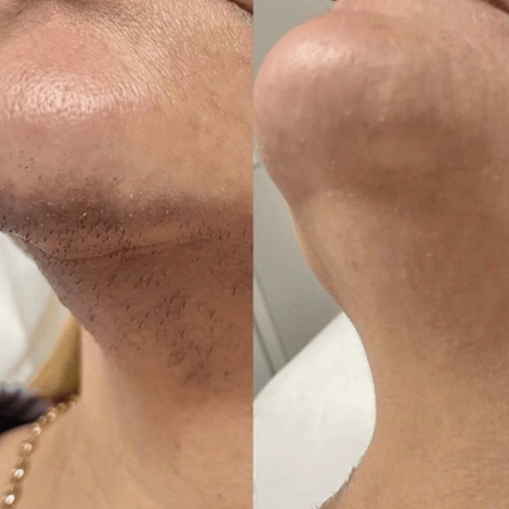 Antes e depois no buço e no queixo, lado a lado