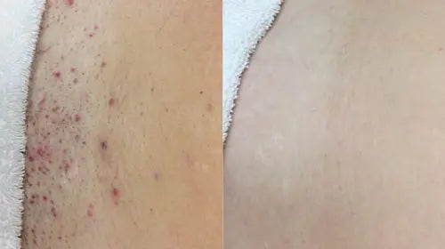 Antes e depois na axila, com a pele irritada à esquerda e mais uniforme à direita