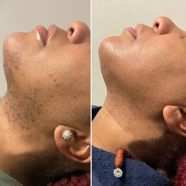 Antes e depois no pescoço, lado a lado
